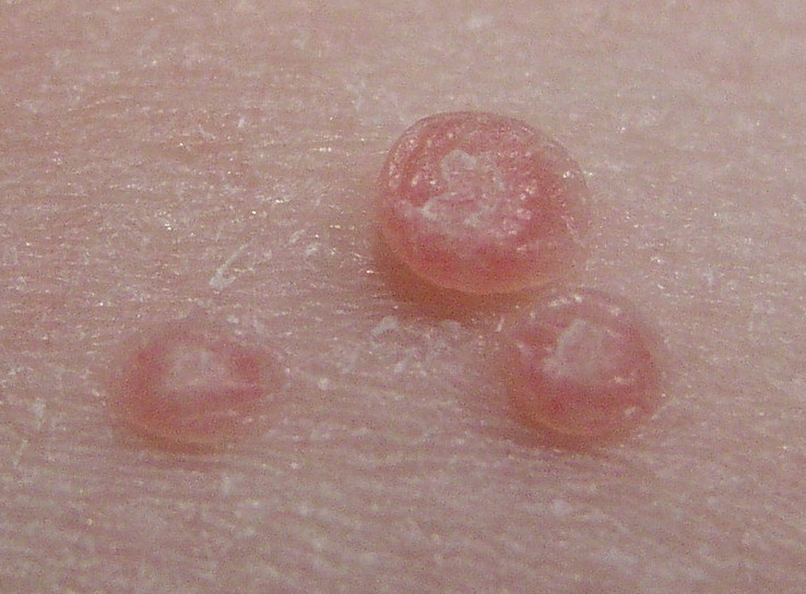 Molluscum bumps